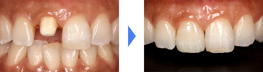 天然歯と調和のとれる前歯にしたい