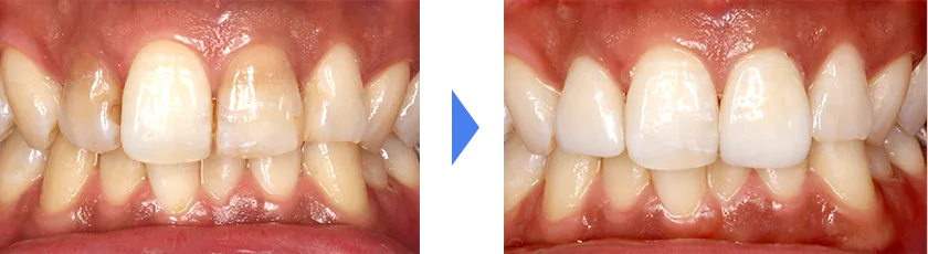 失活歯（神経がない歯）の色が気になる