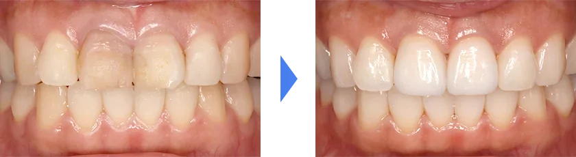 失活歯（神経がない歯）の色が気になる