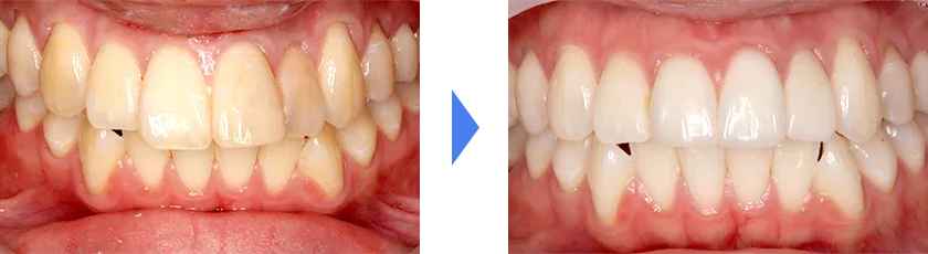 歯冠の長さと歯の色を改善したい