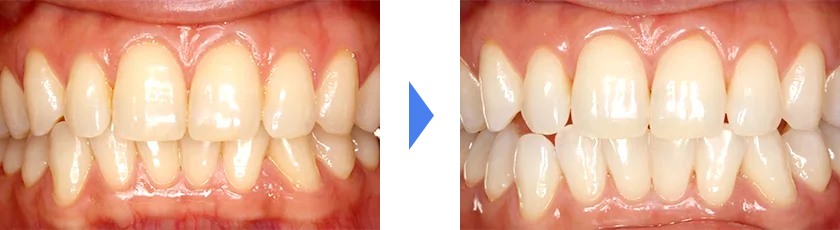 ホワイトニング