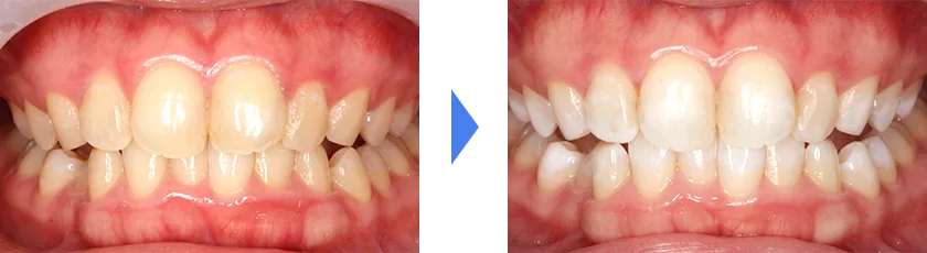 ホワイトニング