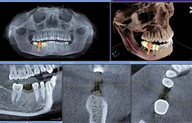 歯科用CT