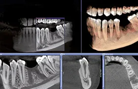 歯科用CT