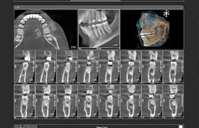 歯科用CT